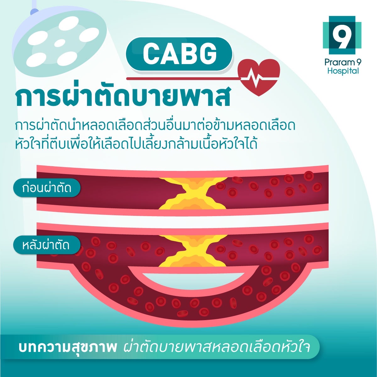 cabg คืออะไร