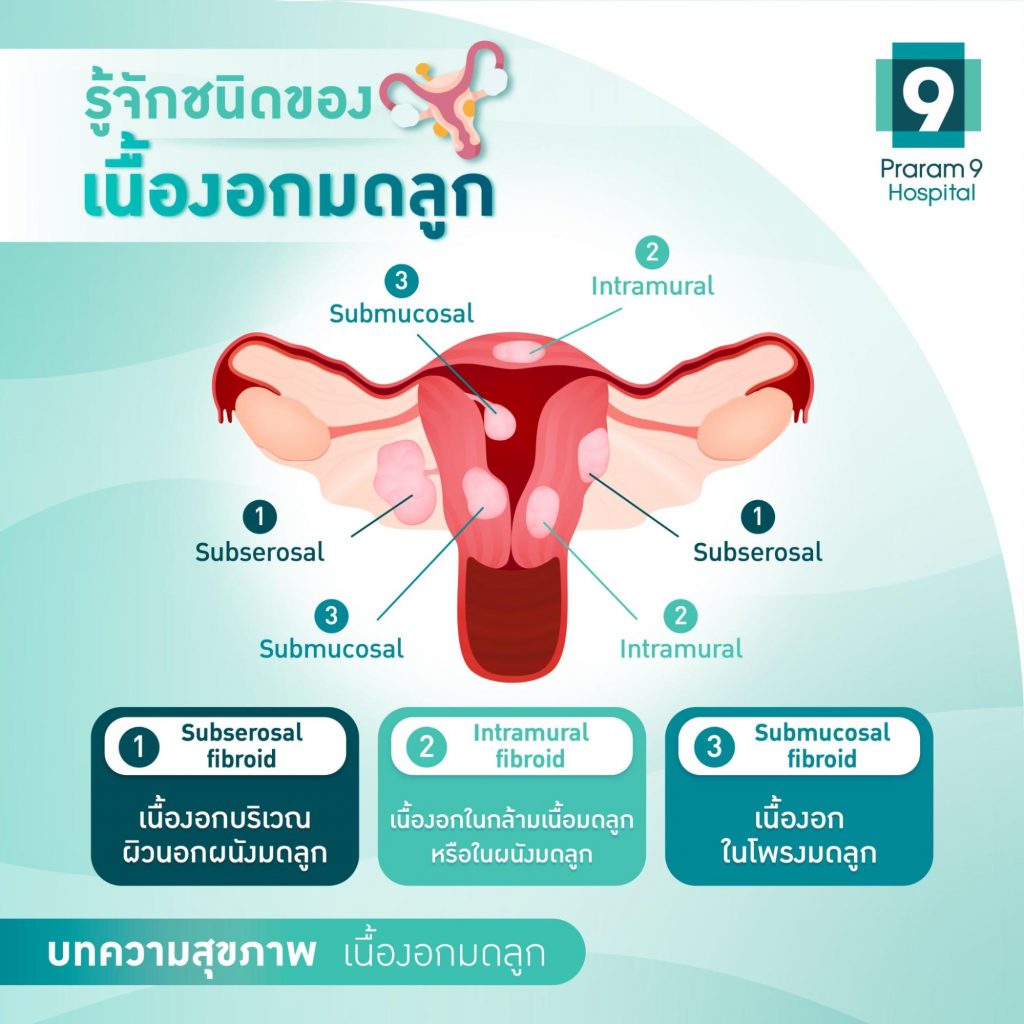type-of-fibroids